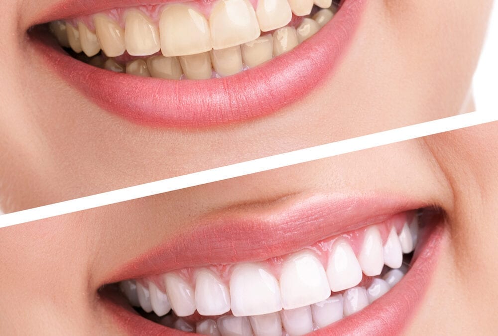 The Art Of Smile Makeover In Cosmetic Dentistry