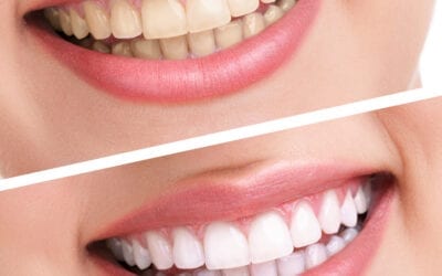 The Art Of Smile Makeover In Cosmetic Dentistry