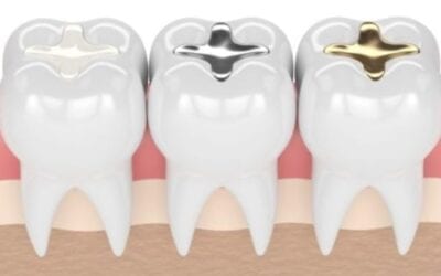 Teeth Fillings: What You Need To Know