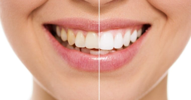 When Getting Cosmetic Dentistry, Take This Into Account