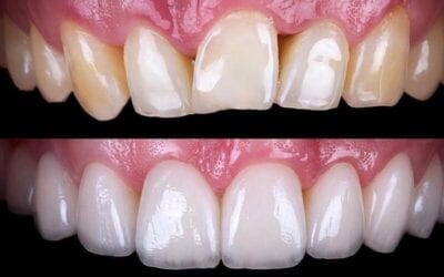 Dental Veneers: What You Need To Know
