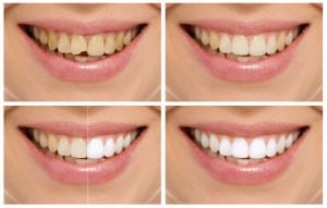 Cosmetic Dentistry Procedure: Do You Need It?